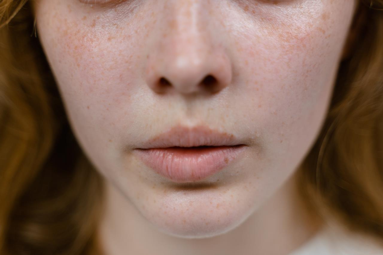 Czy wiotkość skóry może ustąpić samoistnie w ciągu 12 miesięcy?
